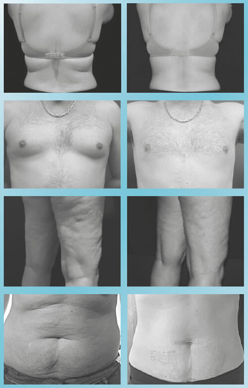 Before And After Photos For Ice Lipo Treatments Provided By Silk Finish Beauty Salon In Blenheim